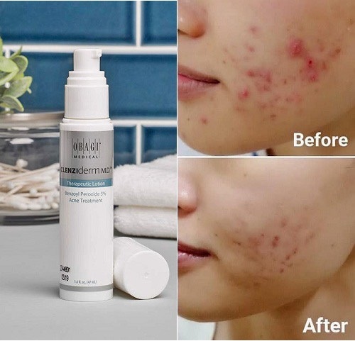 lotion cham mun chua Benzoyl Peroxide Obagi CLENZIderm MD Therapeutic