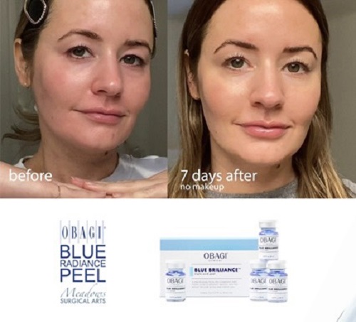 Bo peel tai cau truc nen da Obagi Clinical Blue Brilliance Triple Acid Peel