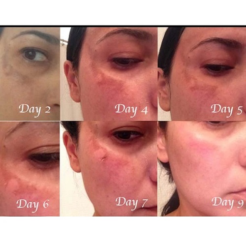 Bo peel tai cau truc nen da Obagi Clinical Blue Brilliance Triple Acid Peel