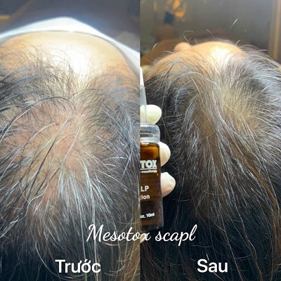 MESOTOX SCALP SOLUTION dieu tri da dau va rung toc 1