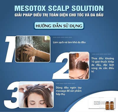MESOTOX SCALP SOLUTION dieu tri da dau va rung toc 1