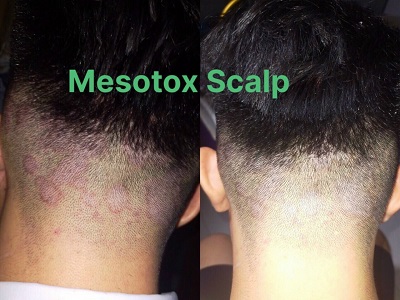 MESOTOX SCALP SOLUTION dieu tri da dau va rung toc 1