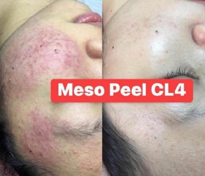 meso peel CL4 peel thap duoc Han Quoc 1