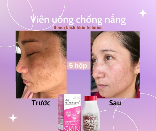Vien uong chong nang