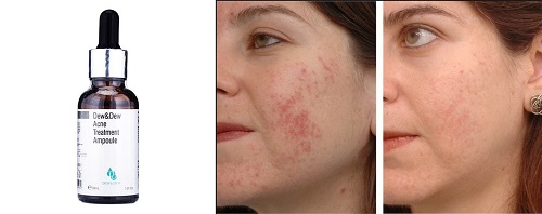 serum tri mun acne
